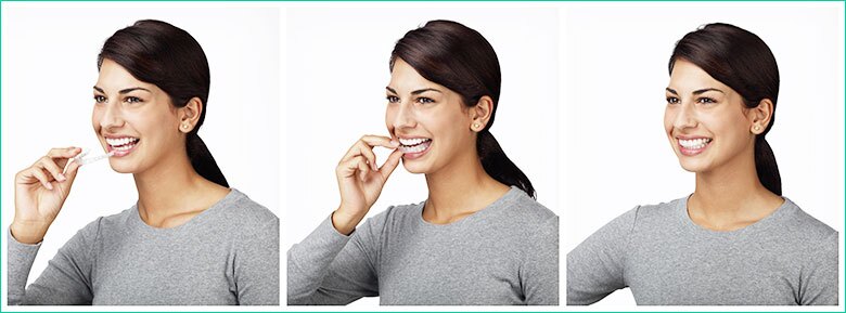 invisalign clear braces toronto west village dental clinic triassi