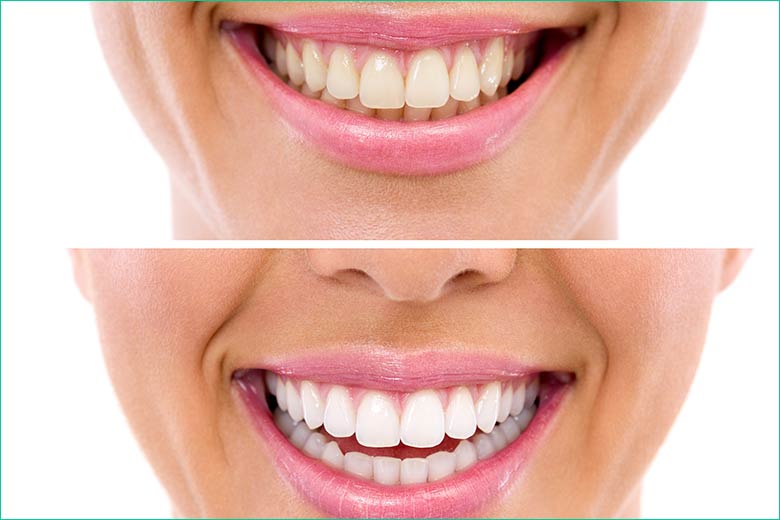 teeth whitening - teeth bleaching - west village dental - toronto dentist