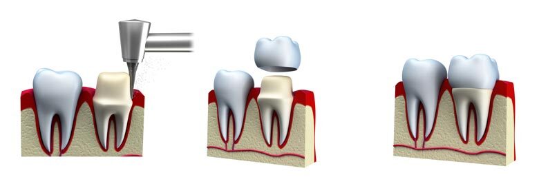 dental cap and dental crown in toronto, on dentist dental office dental crown treatment steps in toronto, on