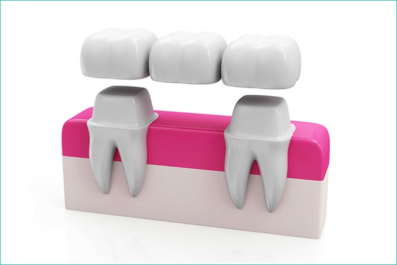 dental bridge in toronto dentist west village dental clinic - dr. triassi