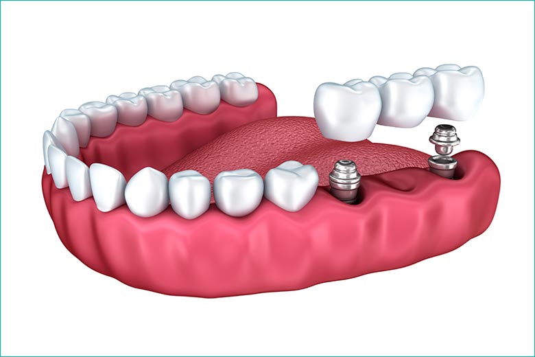 implant-supported dental bridge in toronto - west village dental clinic