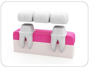 dental bridge - toronto dentist - west village dental