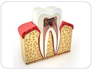 rootcanal treatment emergency dentist in toronto