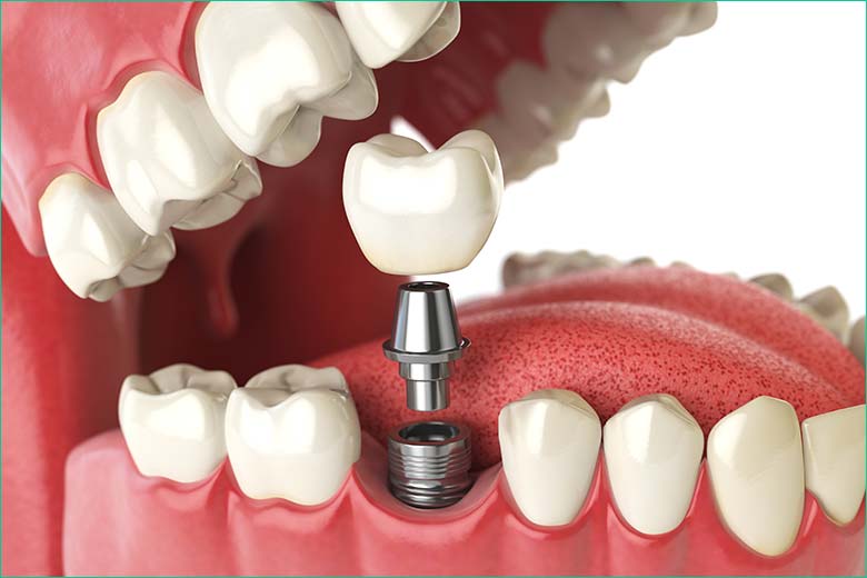 dental implant toronto dentist west village dental clinic dental implant toronto dentist west village dental clinic