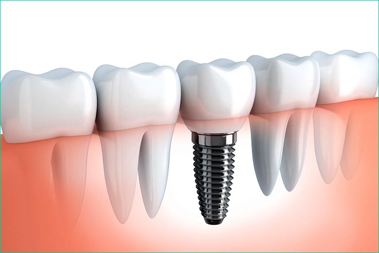 dental implants in toronto - west village dental - dr. triassi dental implants in toronto - west village dental - dr. triassi