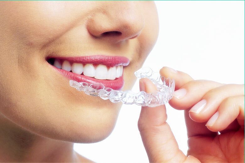 invisalign clear braces toronto west village dental clinic invisalign clear braces toronto west village dental clinic