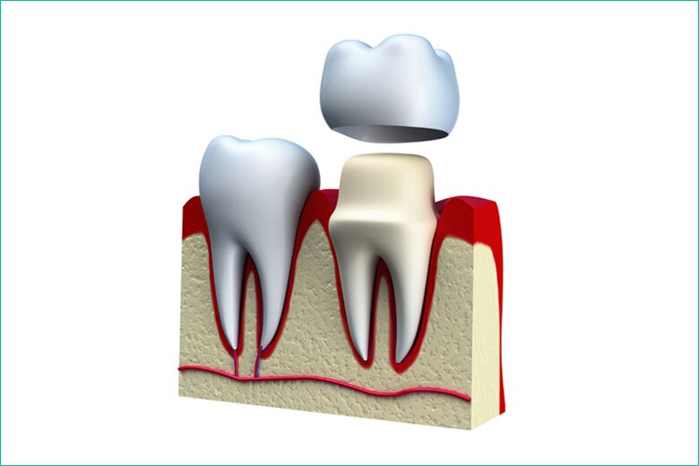 dental crown and dental cap in toronto dentist west village dental clinic - dr. triassi dental crown and dental cap in toronto dentist west village dental clinic - dr. triassi