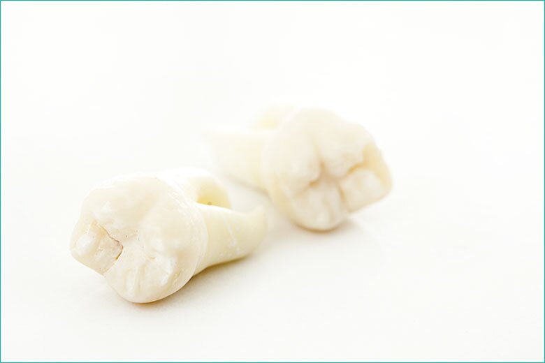 wisdom tooth extraction in toronto - west village dental clinic - dr. triassi wisdom tooth extraction in toronto - west village dental clinic - dr. triassi