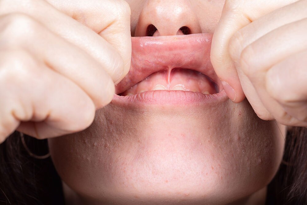 tongue tie treatment toronto dentist frenum