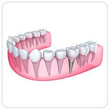 dental-implants-west-village-dental-toronto