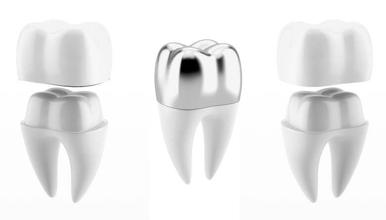porcelain dental crown, metal dental crown, porcelain fused to metal dental crown
