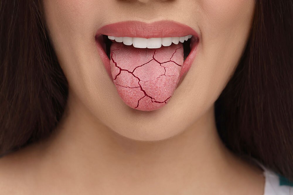 xerostomia how to fix a dry mouth toronto dentist
